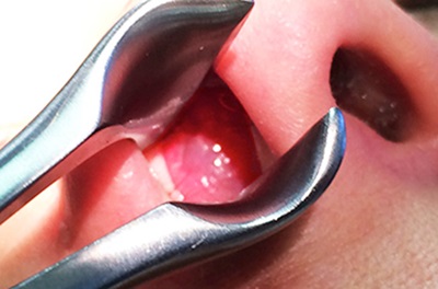 Large polyp completely obstructing the right nostril 